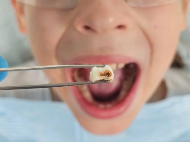 Best Tooth Infection Emergency Dentist  in Proctor, VT